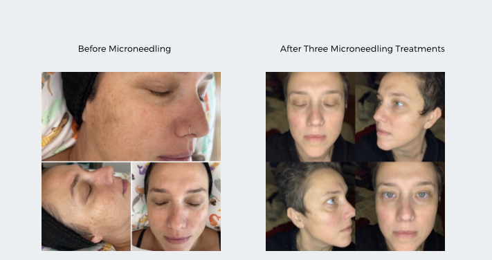 image showing before and after from microneedle treatment