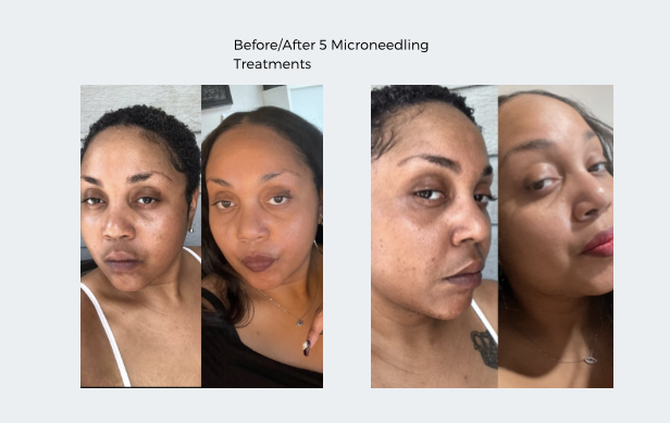 Image showing before and after from microneedle treatment